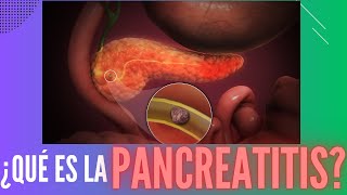 ¿Qué es la pancreatitis [upl. by O'Neil423]