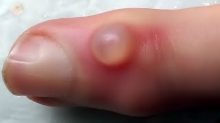 Infected Cyst Popping Extraction [upl. by Kaden223]