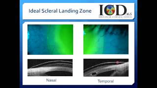 Scleral Contact Lenses Video 5 [upl. by Quirita]