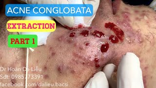 Mụn trứng cá mạch lươn nặngDermatologistpimpleswhiteheadacne conglobata extraction before after [upl. by Sandro592]