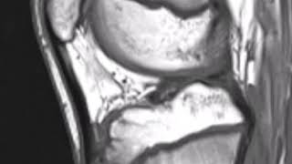 OsgoodSchlatter Disease [upl. by Inoy776]