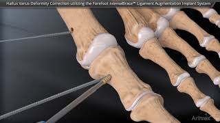 Hallux Varus Deformity Correction Using the Forefoot InternalBrace™ Ligament Augmentation Implant Sy [upl. by Lepp]