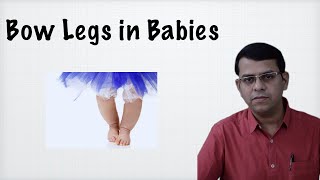 Bow legs in Babies [upl. by Orferd]