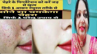 pigmentation treatment at home 🏡 👌pigmentation treatment on face [upl. by Inad]