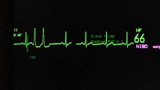 sinus rhythm with ventricular extrasystoles on an ECG monitor [upl. by Ellehcar]