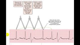 EKG EXTRASYSTOLES [upl. by Iraam]