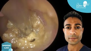 1226  Complex amp Challenging Ear Wax Removal [upl. by Mushro864]