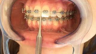 Detallaje amp Finalización en Ortodoncia [upl. by Adnahc]