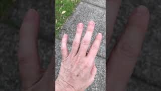 Dystonia with essential tremor [upl. by Htinnek]