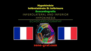 Échocardiographie  Hypokinésie Inférolatérale Et Inférieure [upl. by Arobed]