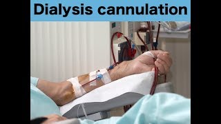 Cannulation Introductory for dialysis การเจาะเส้นคนไข้ไตเทียม [upl. by Rudie]