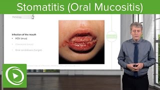 Stomatitis Oral Mucositis – Pediatric Infectious Diseases  Lecturio [upl. by Gnas]