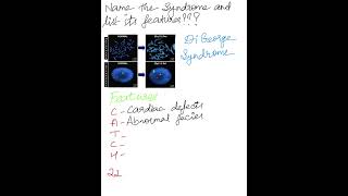 Identify The Syndrome and List the Features Syndromes MedicalMnemonics [upl. by Oiligriv]