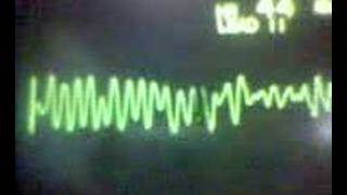 ECG Video Ventricular Fibrillation [upl. by Atteynad]