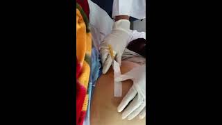 Tapping procedure for Ascites quot Paracentesis quot 1 [upl. by Ammann]