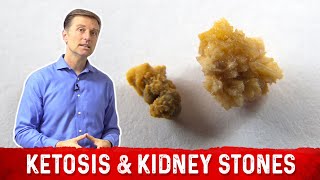 Ketosis and Kidney Stone Prevention – Dr Berg [upl. by Onilatac]