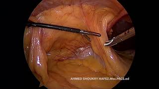 CME amp CVL FOR HEPATIC FLEXURE CA WITH VOICE [upl. by Yednil366]