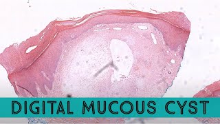 Digital mucous cyst Digital myxoid cyst similar to ganglion cyst pathology dermpath dermatology [upl. by Karmen982]