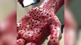 Do You Have Trypophobia The Fear of Holes  The Doctors [upl. by Sedgewake]