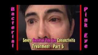 Severe Bacterial Pink Eye Conjunctivitis treatment part 5 [upl. by Alleunamme941]