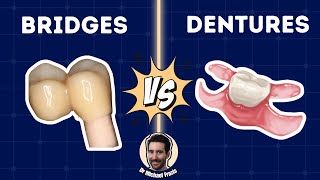 Treatment Planning Bridges vs Dentures  The Art and Science  PDP198 [upl. by Mandie]