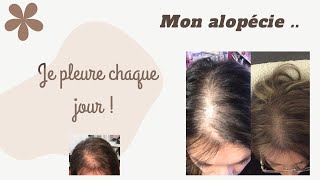 Mon désespoir ALOPECIE ANDROGENETIQUE ⭐ [upl. by Kamerman]