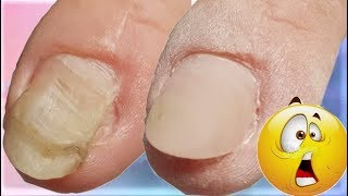 DEFORMIERTER Nagel durch VERLETZUNG😱😱Rekonstruktion eines Nagels nagelverletzung [upl. by Assirat]