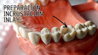 Preparación Incrustación dental Inlay [upl. by Karwan]