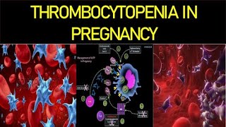 Thrombocytopenia in Pregnancy [upl. by Ateerys]