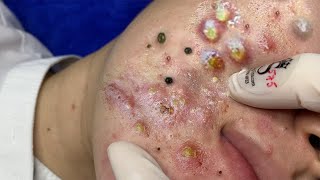 Big Cystic Acne Blackheads Extraction Blackheads amp Milia Whiteheads Removal Pimple Popping  7038 [upl. by Terhune]