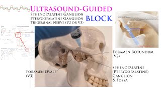 UltrasoundGuided Sphenopalatine Pterygopalatine Trigeminal Nerve Gasserian Ganglion Blocks [upl. by Ahseirej]