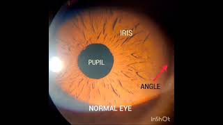 Laser Peripheral Iridotomy for Angle closure glaucoma [upl. by Aleek]