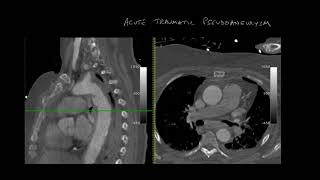 Ductus diverticulum vs Pseudoaneurysm [upl. by Alrrats819]