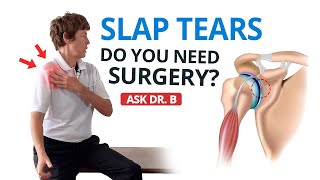 Shoulder Labral Tear  SLAP Lesion Do You Need Surgery Ask Dr B [upl. by Fidela]