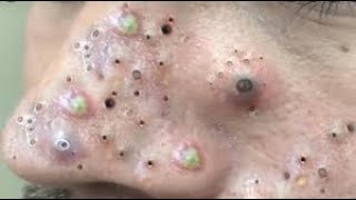 Blackhead Treatment on his nose and face  Acne Treatment  Remove Blackheadquot quotAcne on Forehead [upl. by Semmes]