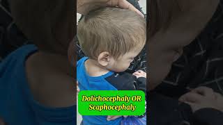 Dolichocephaly  Scaphocephaly Saggital craniosynostosis  abnormal head shape craniosynostosis [upl. by Ailev]