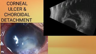 CORNEAL ULCER AND CHOROIDAL DETACHMENT [upl. by Columbus]