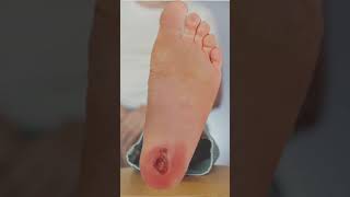 Healing Process of Foot Ulcer We are here We support you through your healing Process [upl. by Bate]