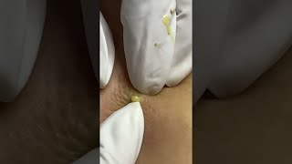 Big Cystic Acne Blackheads Extraction Blackheads amp Milia Whiteheads Removal Pimple Popping shorts [upl. by Maryellen]