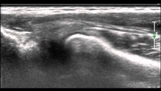 Ultrasonographic diagnosis of snapping annular ligament in the elbow [upl. by Enajharas940]