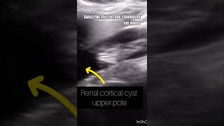 Right Renal upper pole cortical cystUltrasoundkidney [upl. by Esirahs219]