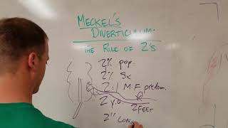 Meckels Diverticulum The Rule of 2s [upl. by Eanat]