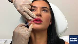 Lip Filler Restylane Injections with Before amp After photos [upl. by Inneg]