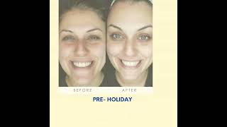 PreHoliday CryoSkin Facial Sale love weightlossformenover40 holiday cryoskin love facelift [upl. by Erialb918]