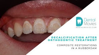 Decalcification after orthodontic treatment Composite restorations in a rubberdam 🦷💡 [upl. by Edlitam]