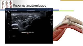 Infiltration intra articulaire du coude sous guidage échographique [upl. by Feldt]
