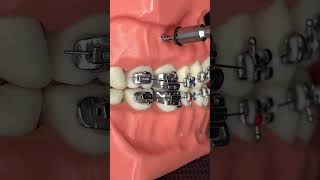 🔥Instalación de tornillos 🔩 en los BRACKETS 😬 SIN DOLOR 😫🔥 [upl. by Beacham]