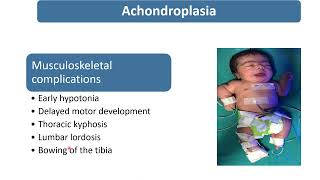 Achondroplasia  Spot Diagnosis  17  Pediatrics [upl. by Tseng]