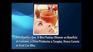 Remedios Caseros Para el Acne Como Eliminar Acne Rapido [upl. by Dosi347]