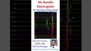 His Bundle electrogram EP Tracing of Sinus Beat [upl. by Adierf]